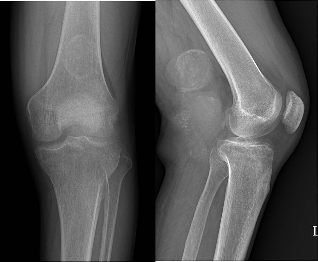 SOFT TISSUE TUMOURS