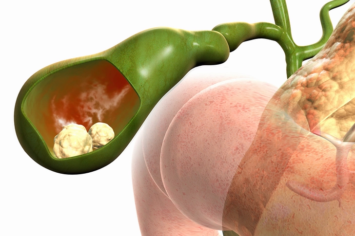 GALL BLADDER SURGERY