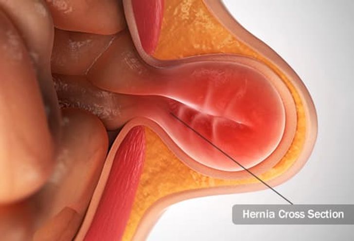 HERNIA SURGERY