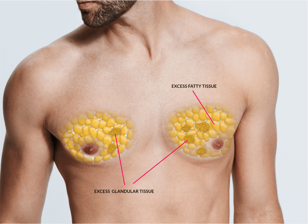 GYNAECOMASTIA
