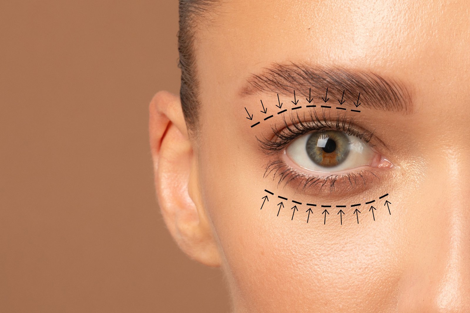 BLEPHAROPLASTY - EYELID SURGERY