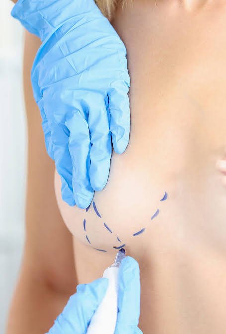 BREAST LIFT