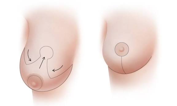 BREAST REDUCTION
