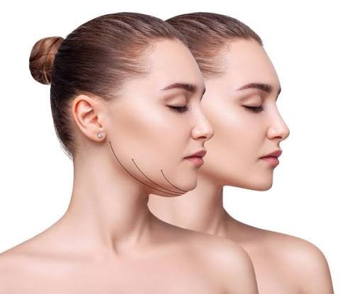 BUCCAL FAT/FACIAL SLIMMING