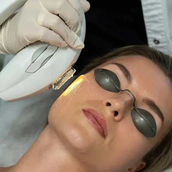 IPL  INTENSE PULSED LIGHT THERAPY