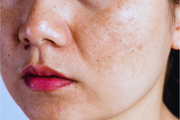 PIGMENTATION/MELASMA