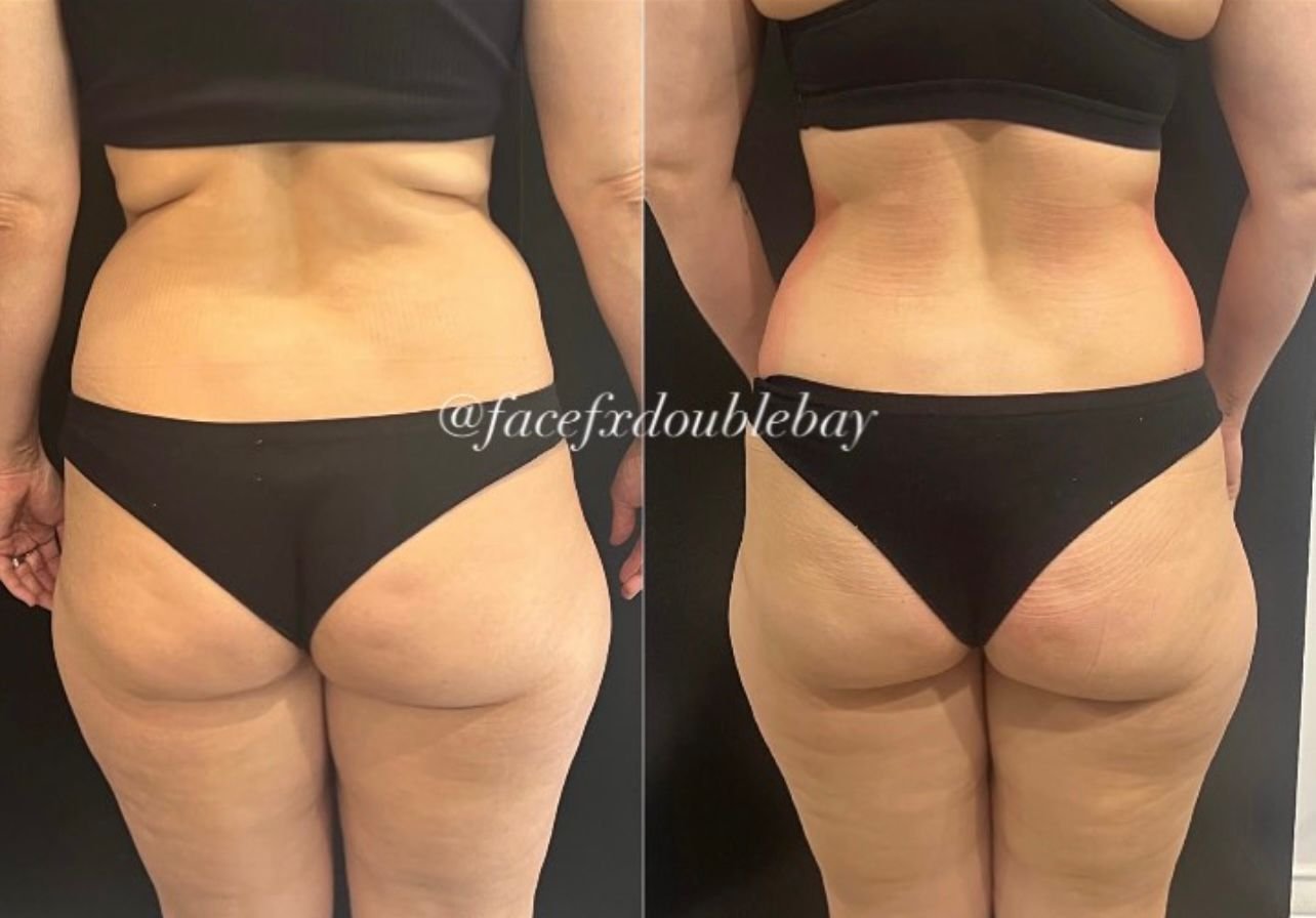 Waist & Hip Contouring