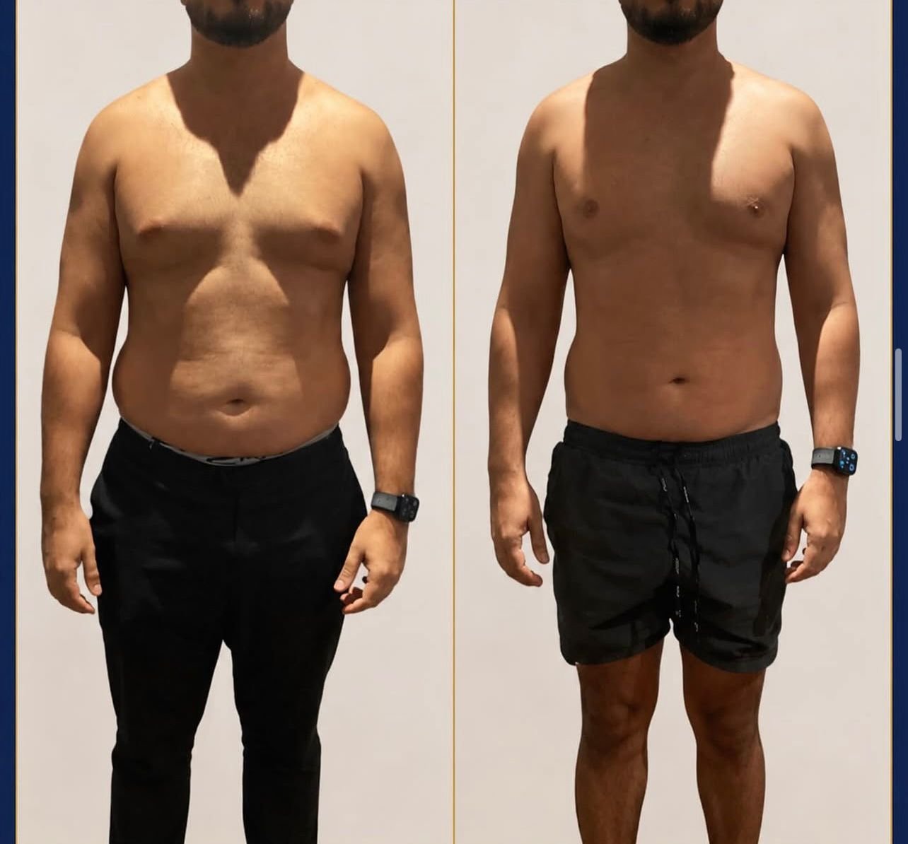 Abdominal Contouring