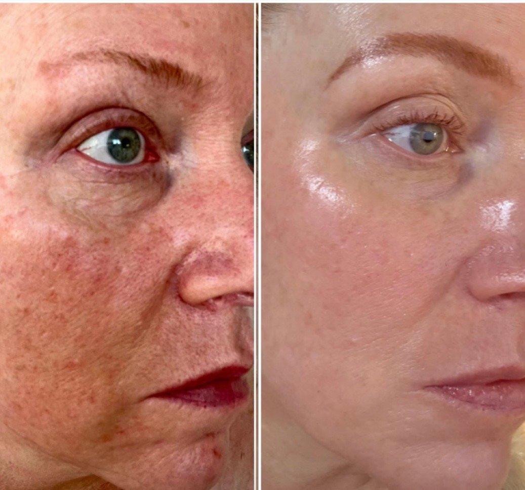 Rosacea Management
