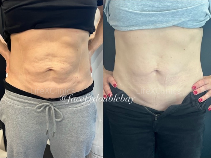 2 x Fat Freezing + 1 RF